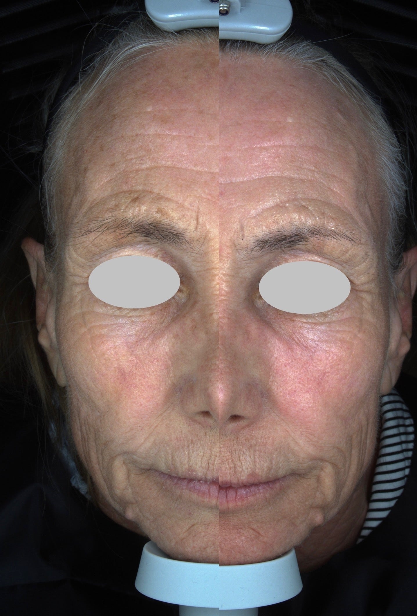 Solas Pro-D Skin Analyzer