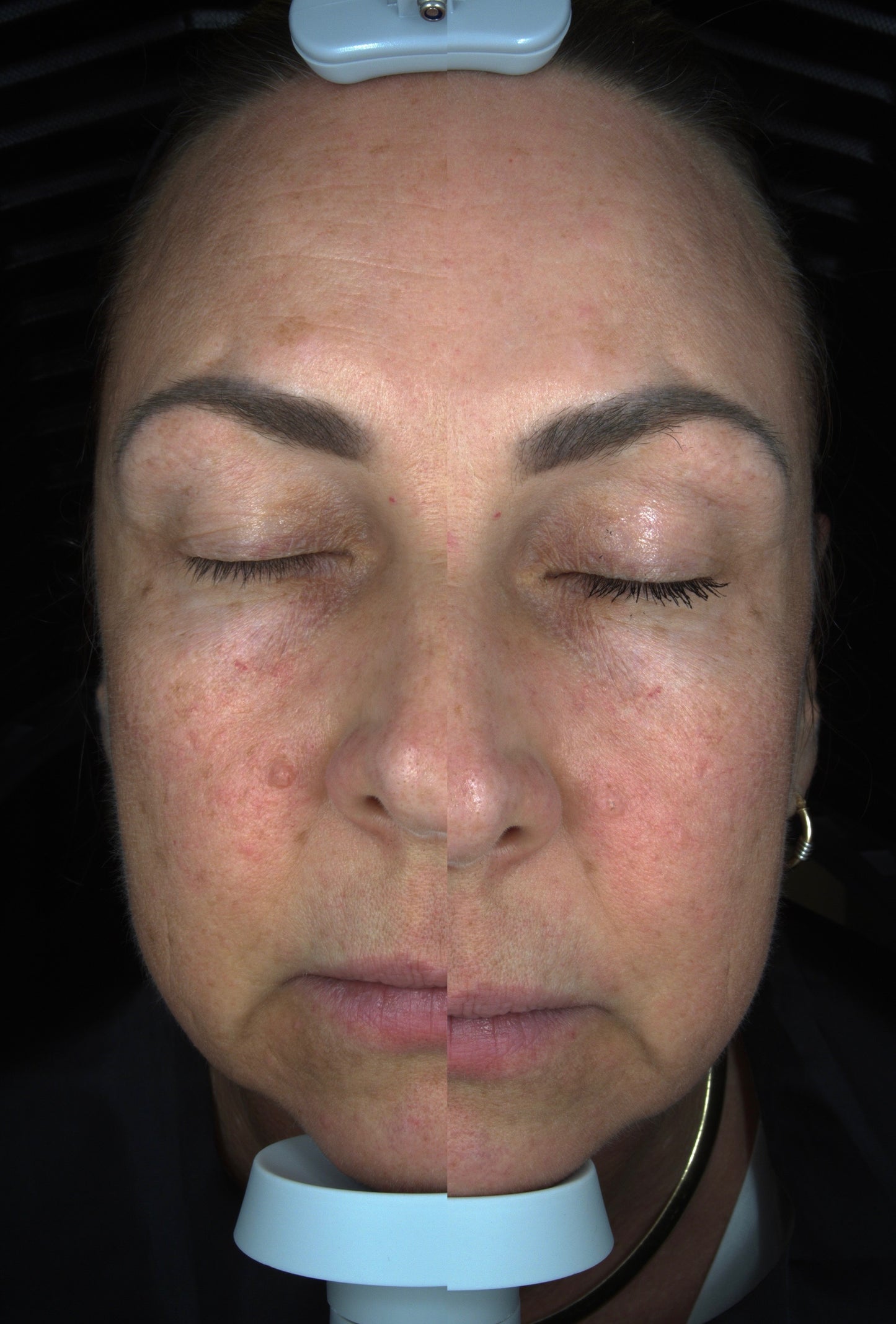 Solas Pro-D Skin Analyzer