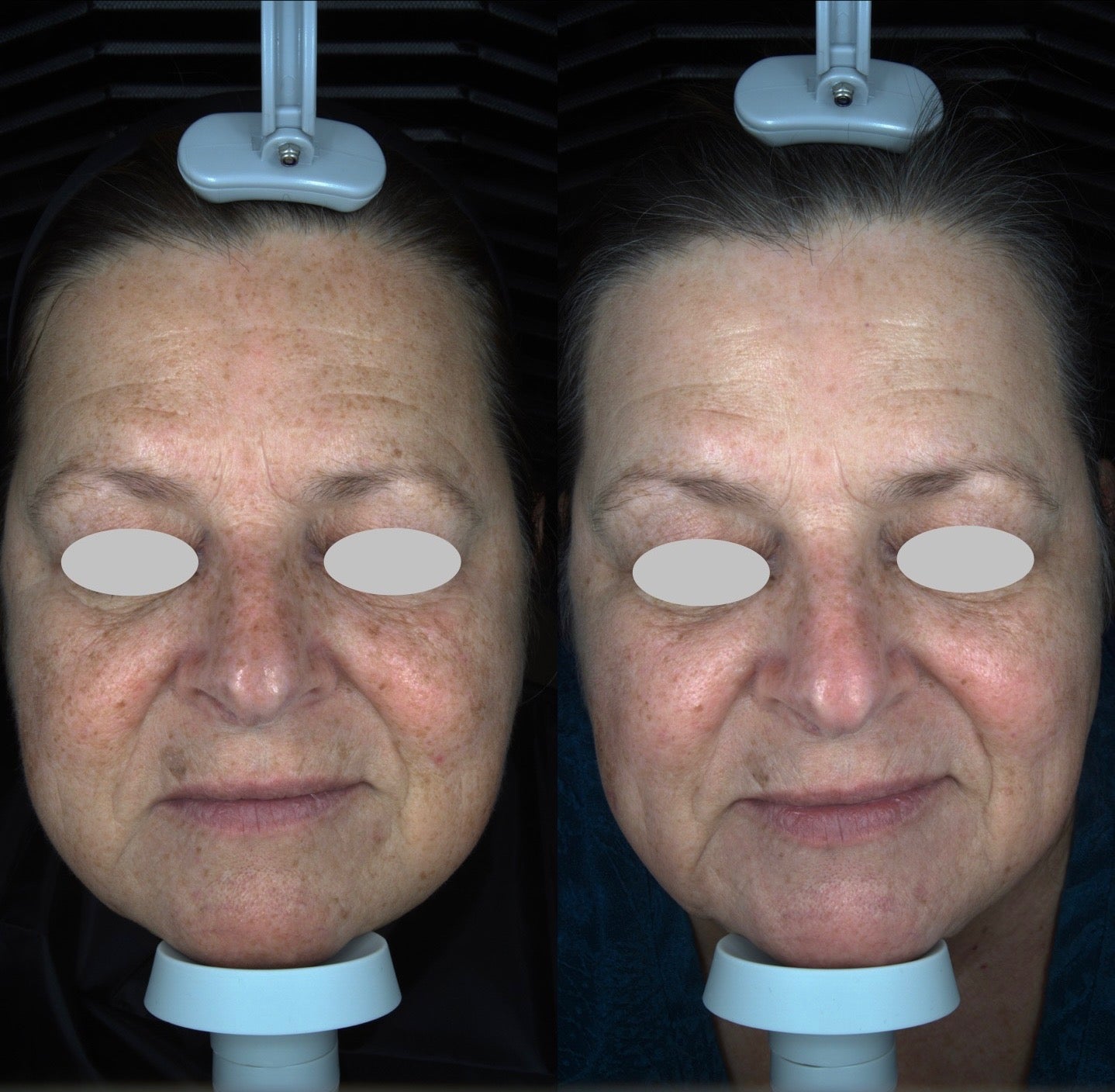 Solas Pro-D Skin Analyzer