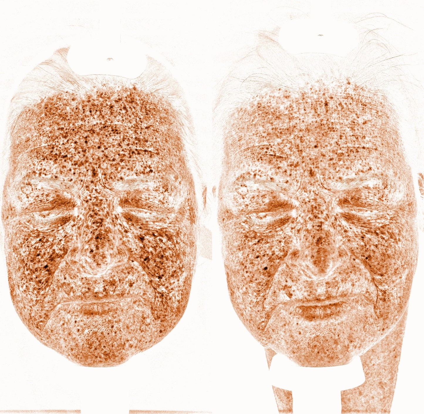 Solas Pro-D Skin Analyzer