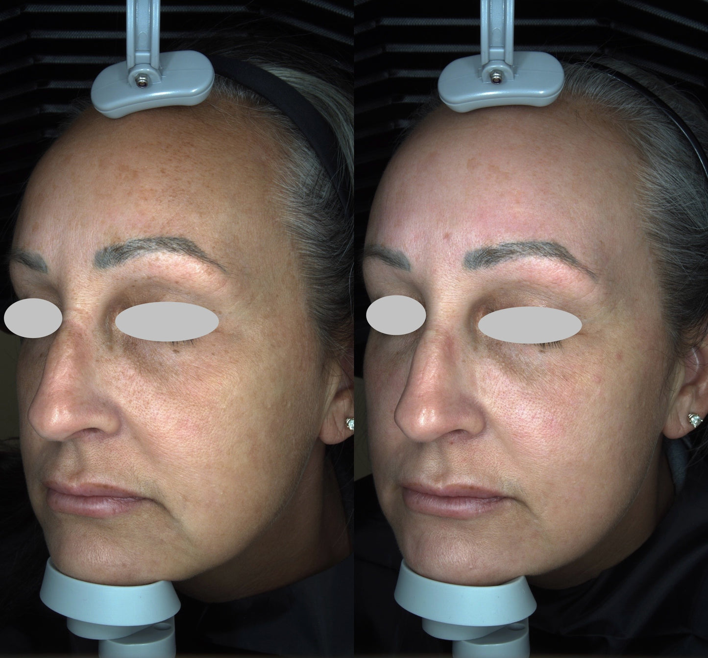 Solas Pro-D Skin Analyzer