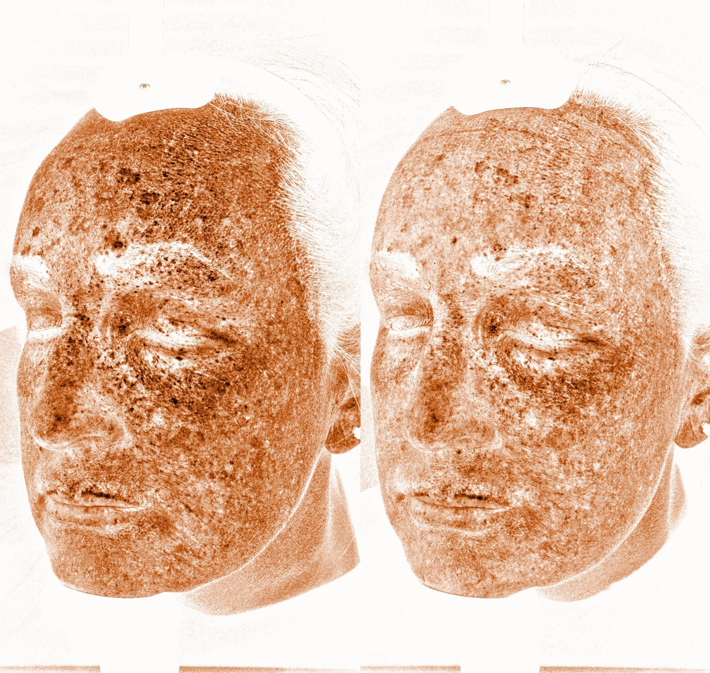 Solas Pro-D Skin Analyzer