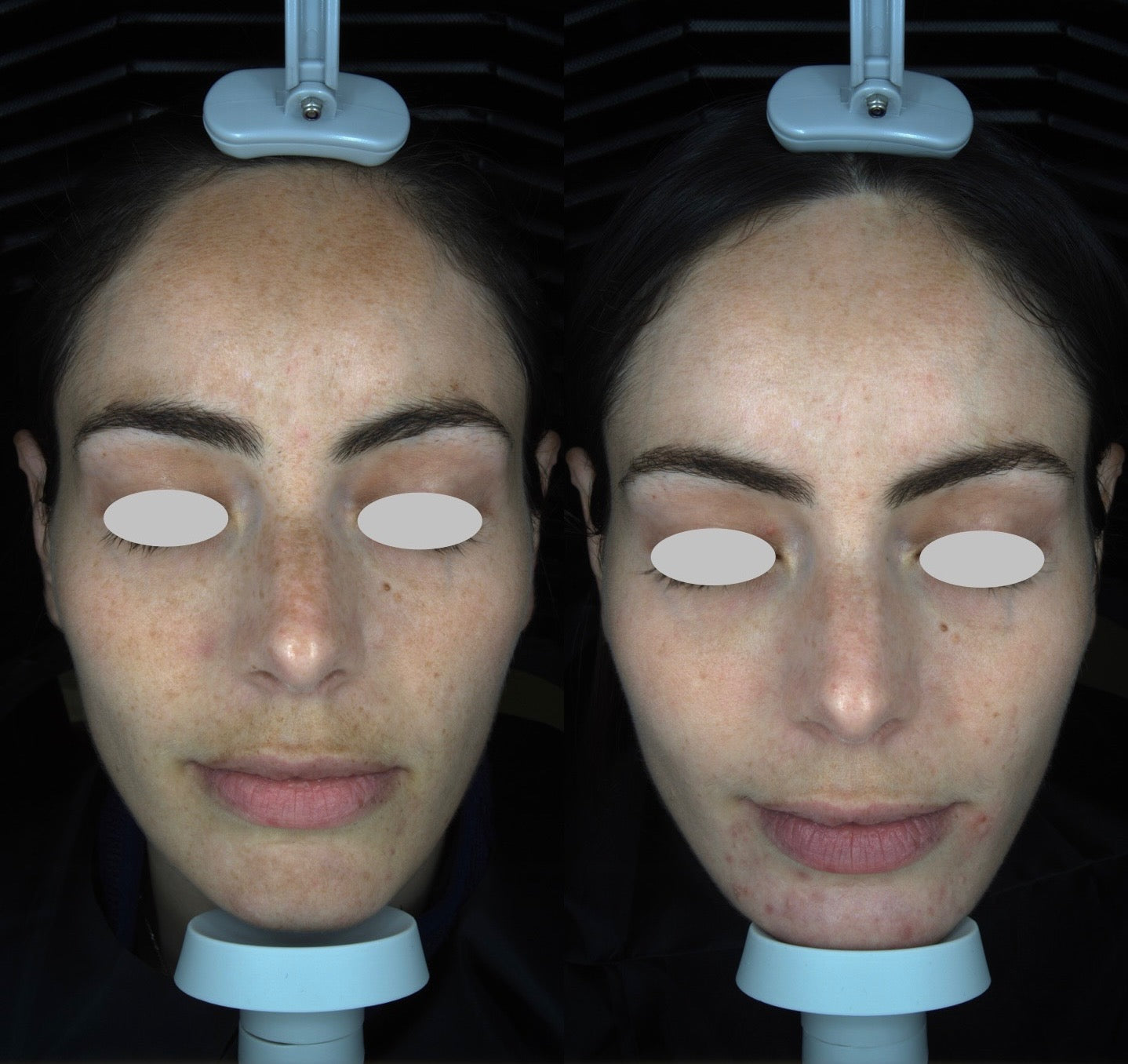 Solas Pro-D Skin Analyzer