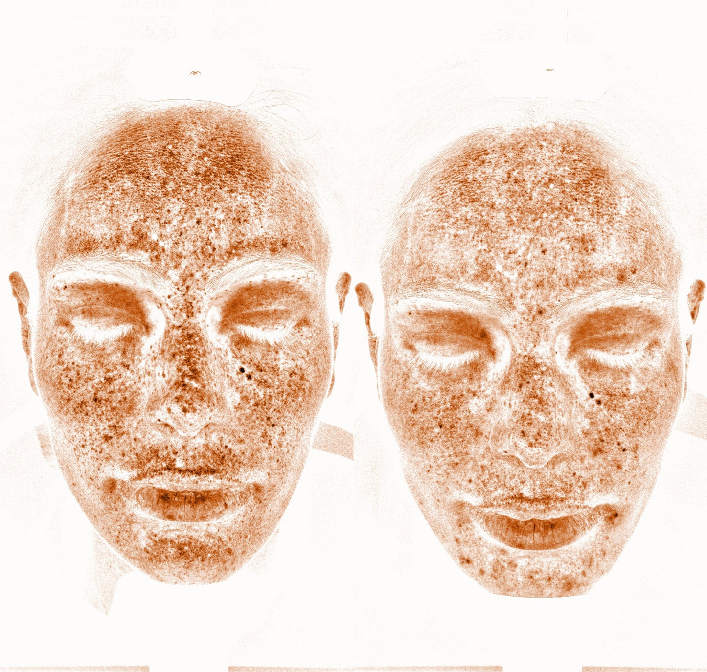 Solas Pro-D Skin Analyzer